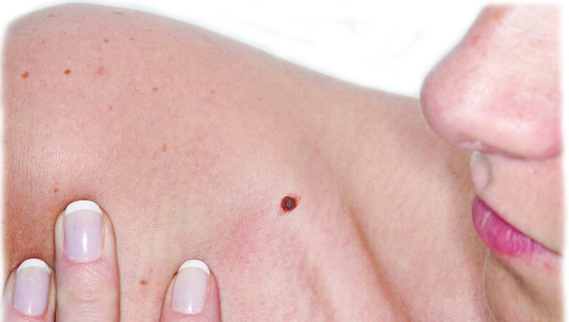 imagen de Prevención  y detección temprana del cáncer de piel