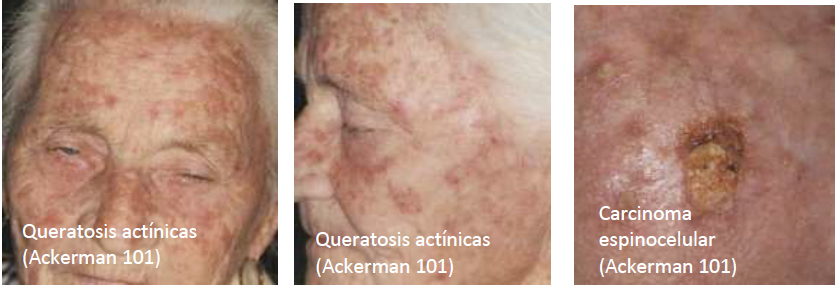 queratosis