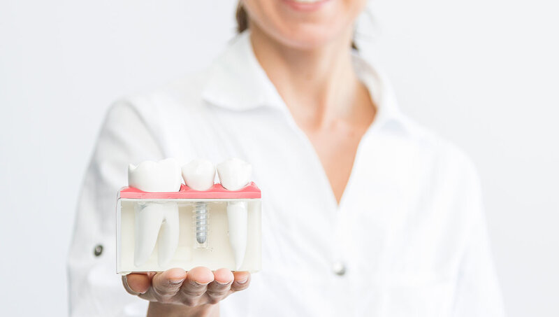 imagen de Implantes dentales: Un tratamiento responsable