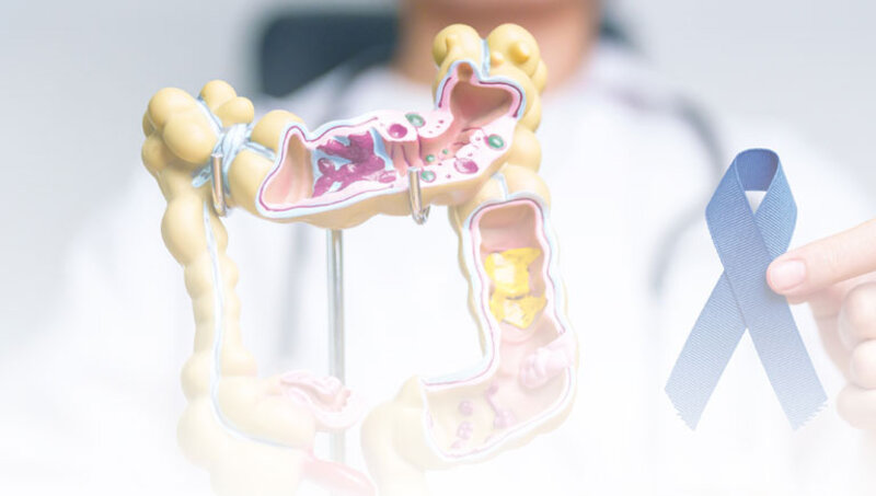 imagen de Cáncer de colon