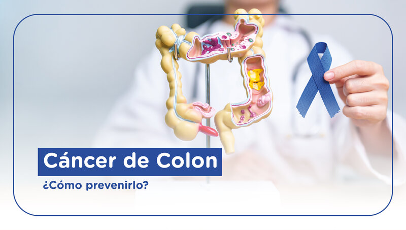 imagen de Cáncer de colon